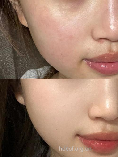 这些做法会毁了你的脸 晒后修复要这么做