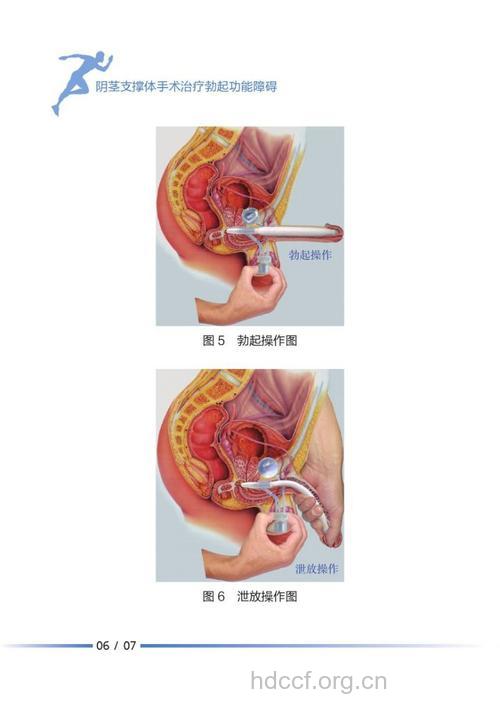 治疗早泄的手术方法有哪些呢