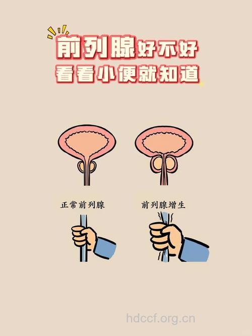 小便射程与前列腺功能