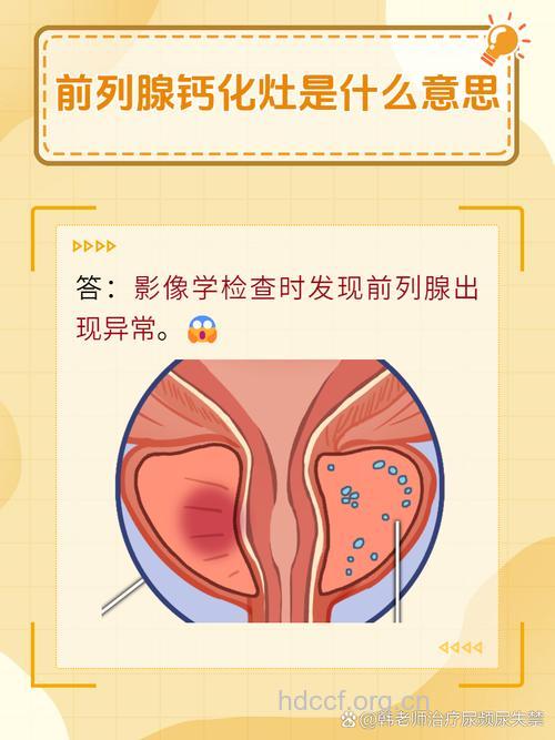 什么是前列腺钙化?