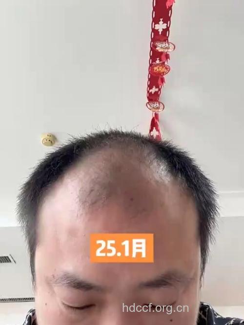 程序员没头发?每天吃鸡蛋可预防脱发