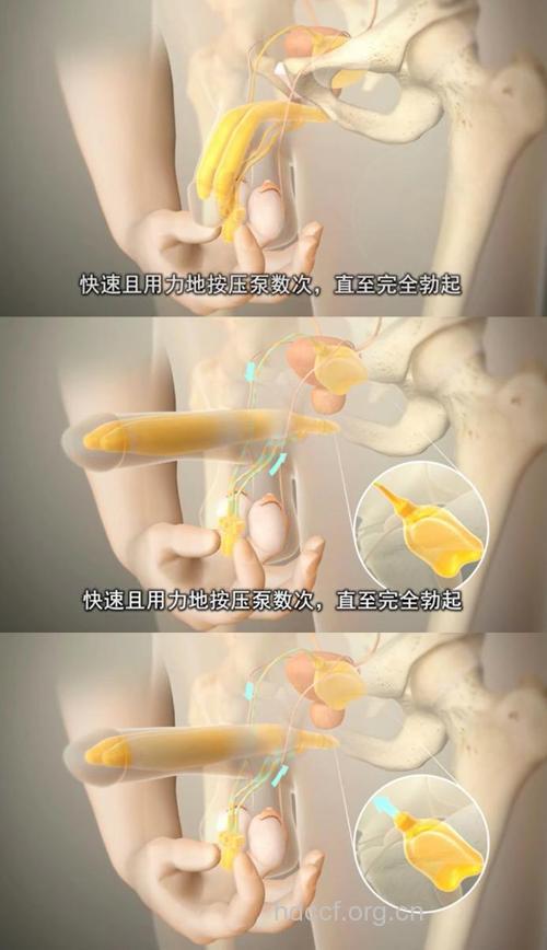 男人勃起障碍该怎么办