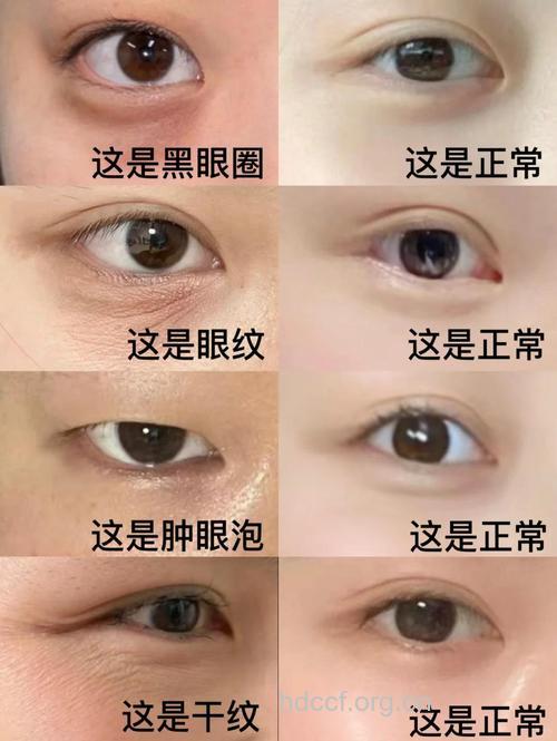 男士眼部细纹黑眼圈 该如何应对眼部肌肤问题