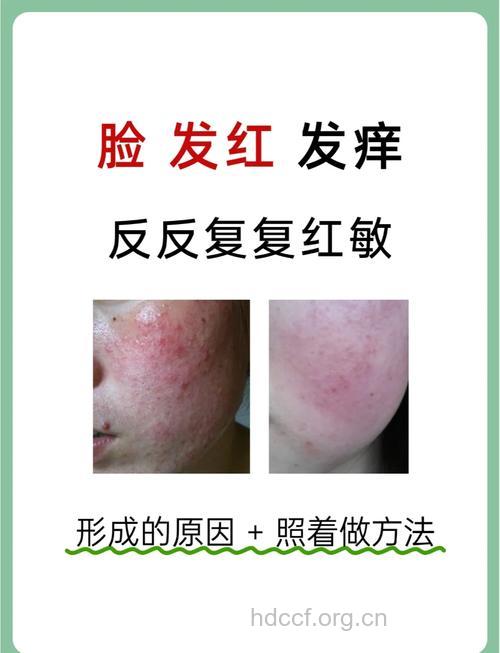 脸部发红过敏可以这样来治疗
