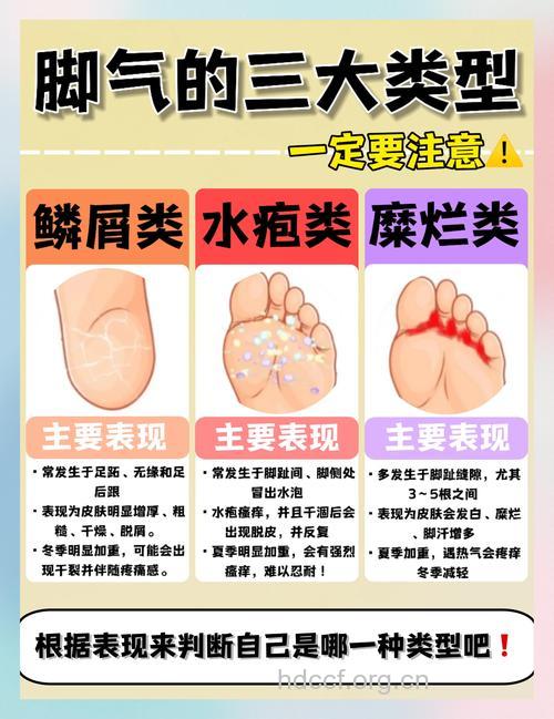 男人易脚臭 3个原因导致
