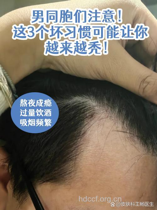 7个坏习惯让男性头发越来越少