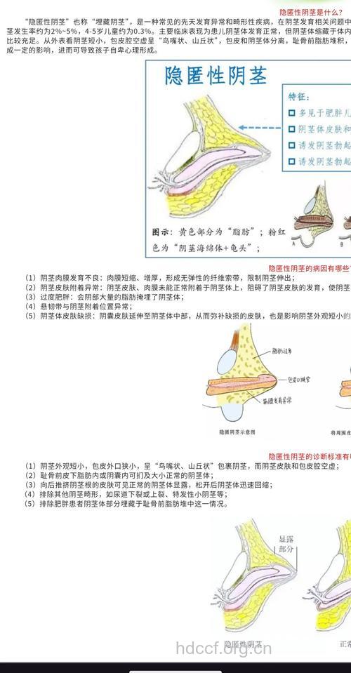 阴茎短小怎么治 推荐3个手术方法