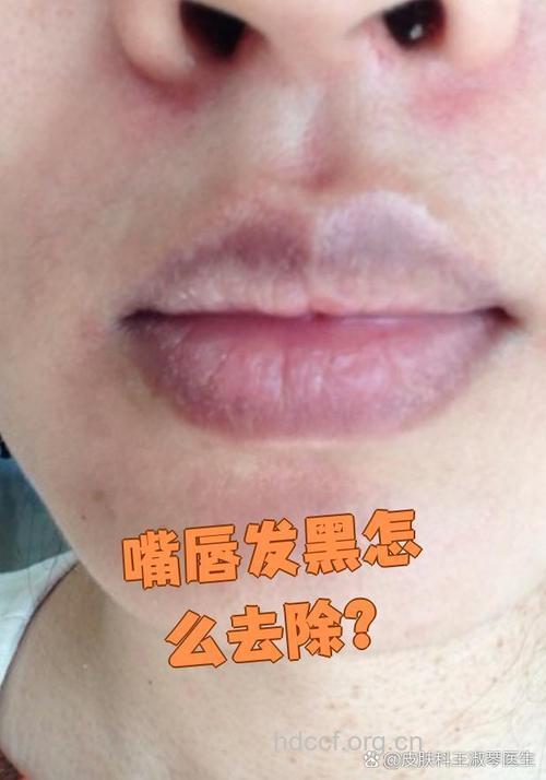 出现嘴唇发黑可能是消化系统异常