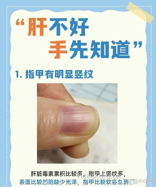 指甲为何出现竖纹凹陷 需对症来治疗