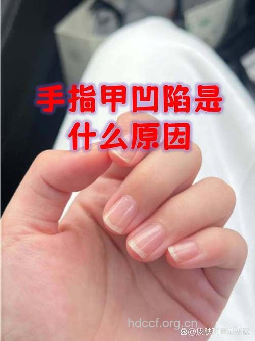 无名指指甲凹陷 或是这些疾病在作祟