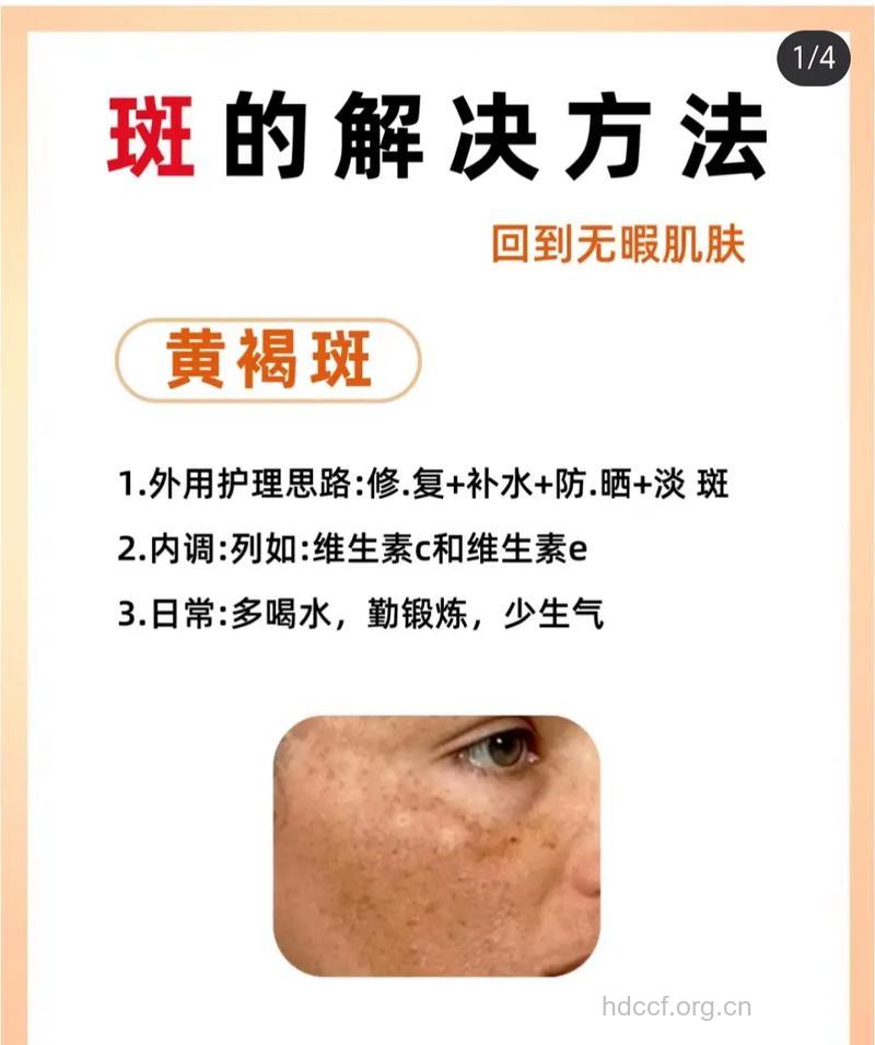 男人脸上长雀斑怎么办 轻松祛斑排毒方法