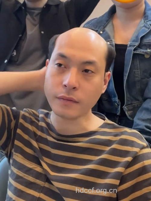 程序员竟是脱发高发人群