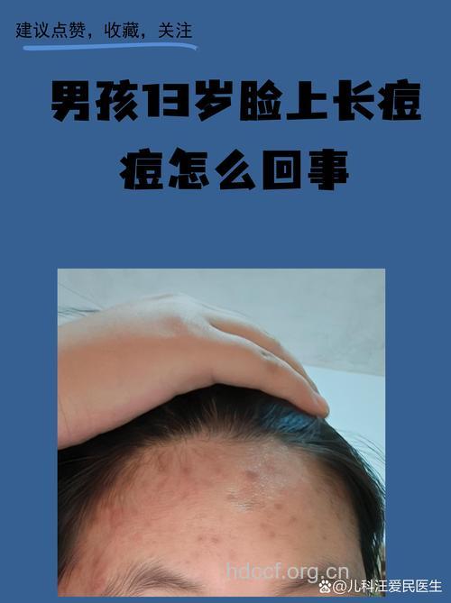 浅谈男性荷尔蒙与青春痘的关系
