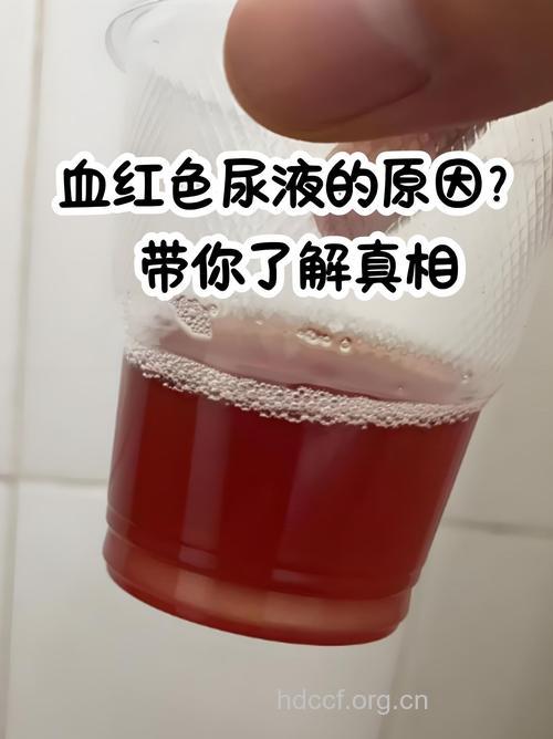 男人小便呈血红色怎么回事 三招帮你预防