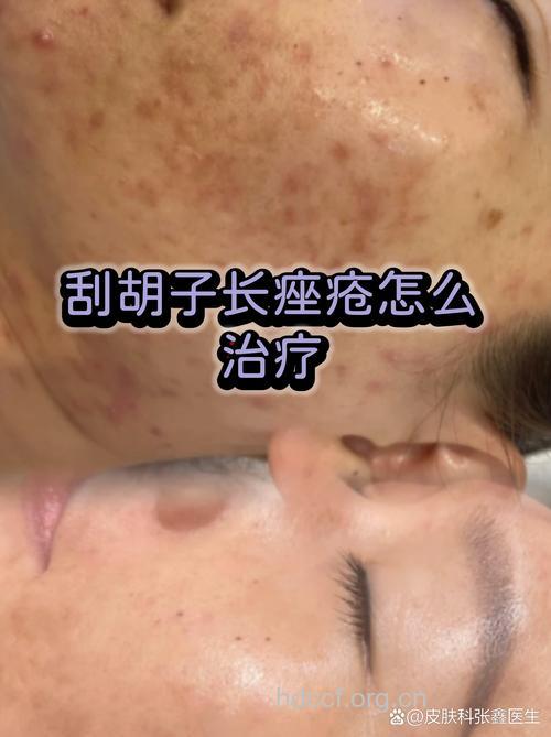 胡子上长痘怎么回事？不要从不同方向剃须