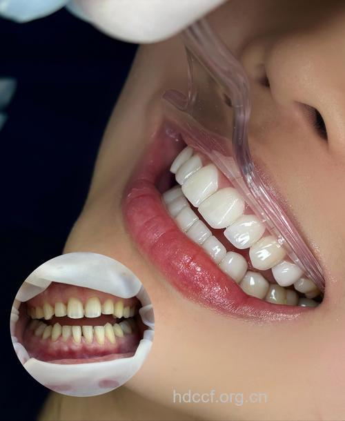 男人想要一口大白牙 这么做就够了