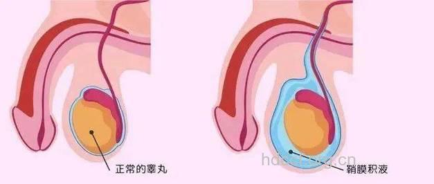 睾丸蠕动正常吗?男性生殖保养刻不容缓