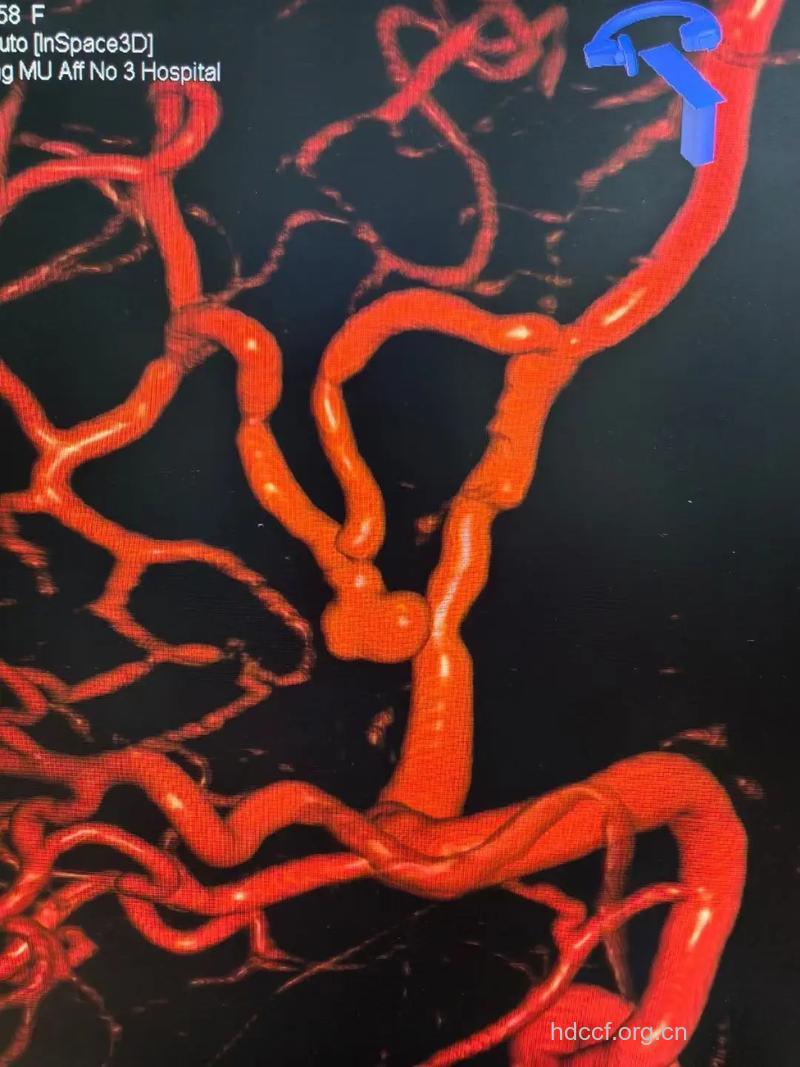 高血压与可怕的动脉夹层瘤