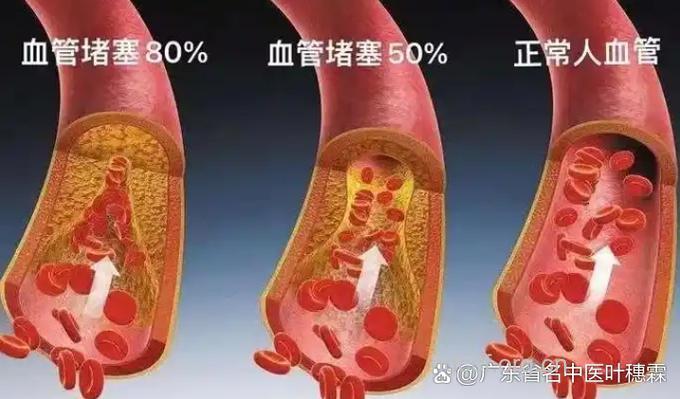 水桶腰危害心血管