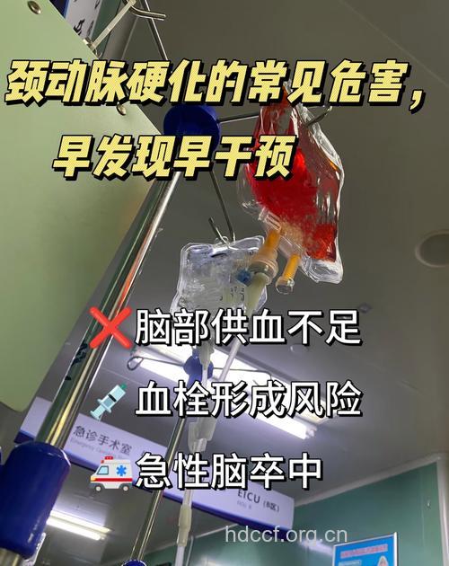 颈动脉狭窄硬化者仰头危险