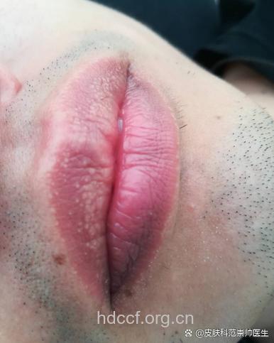男人嘴唇发白是怎么一回事