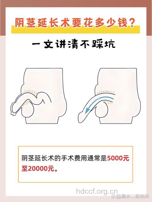 阴茎延长术的费用是多少