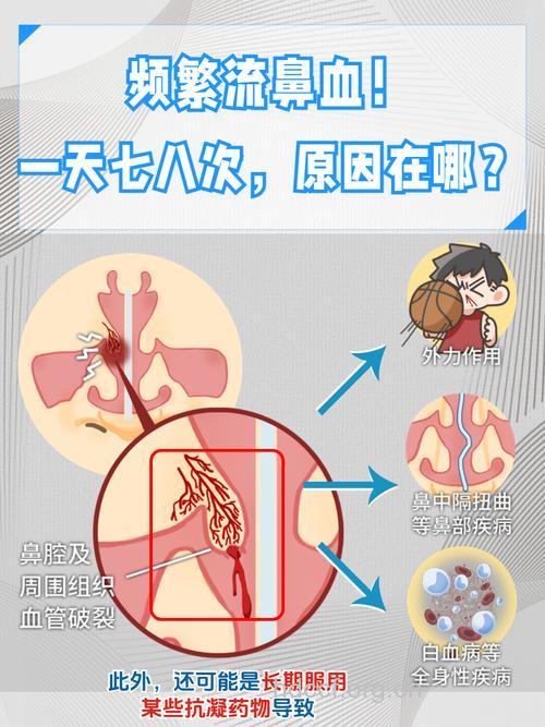高血压与鼻出血是否有关