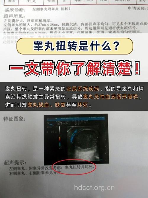 睾丸扭转的“前世今生”