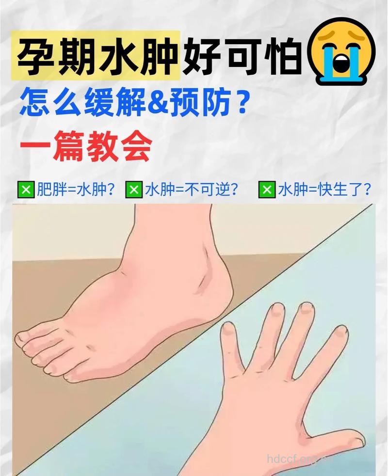 孕妇水肿警惕娠高征