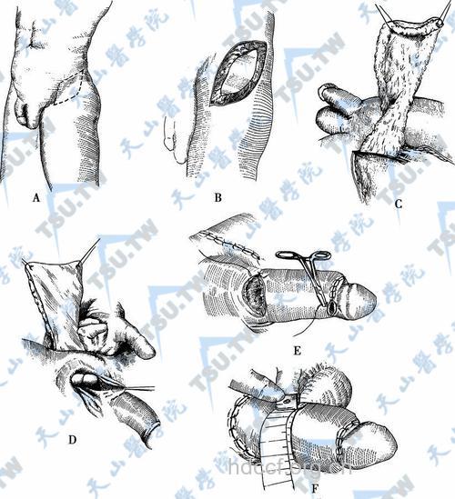 常见的阴茎增大手术方法