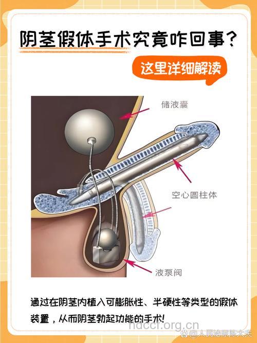什么是人工阴茎