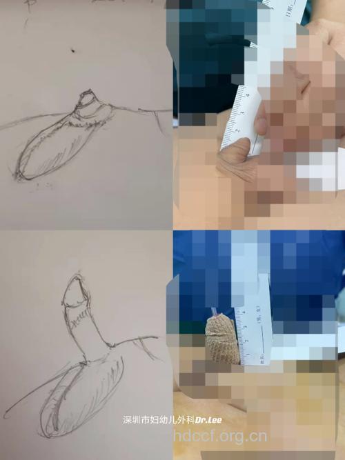 什么是男性隐匿型阴茎