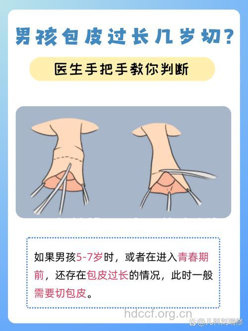 小孩包皮过长也要认真对待