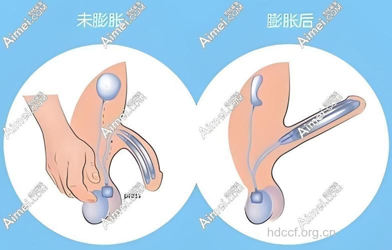 阴茎延长手术前后有哪些注意