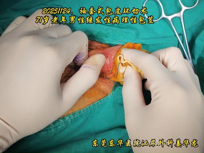 什么是包茎环切手术