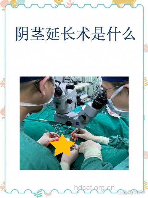 阴茎延长术的误区有哪些