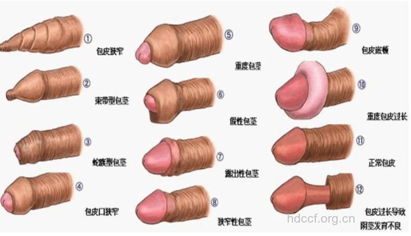 包茎的3个类型