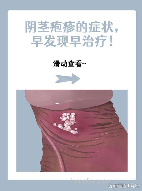 男人得性病的6个早期反应