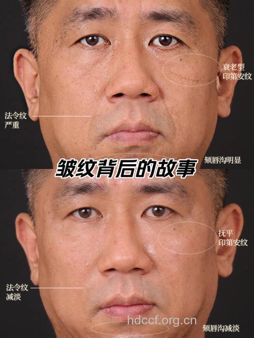 脸上长9种皱纹 暗示你有病了