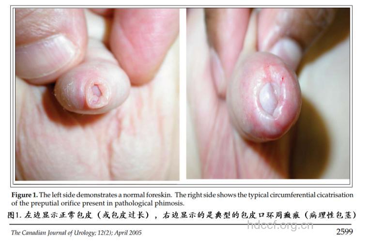 包皮过长长什么样子的