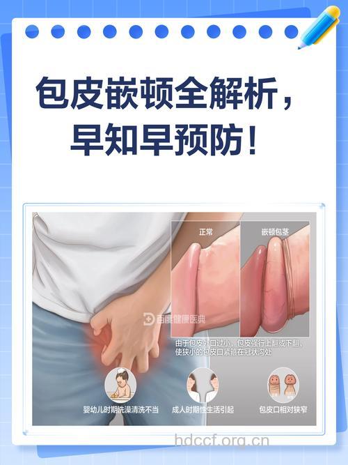 什么是包皮嵌顿呢