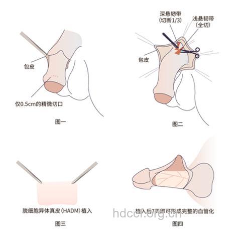阴茎延长术该怎么做