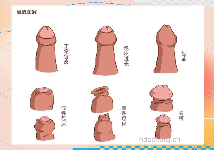 包皮过长与前列腺健康