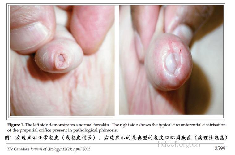 包皮过长会不会影响做爱