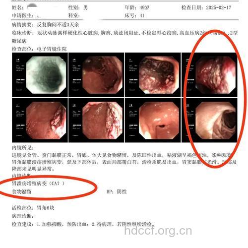 胃肠癌患者必做的检查有哪些