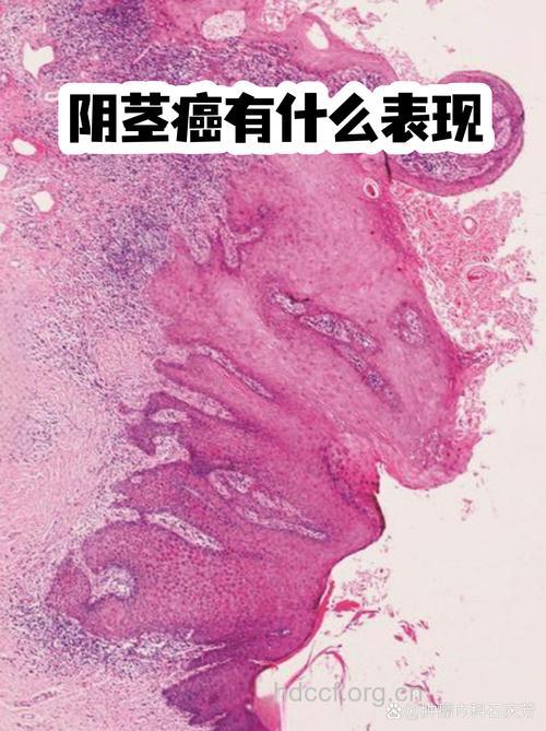 包皮异常警惕阴茎癌!