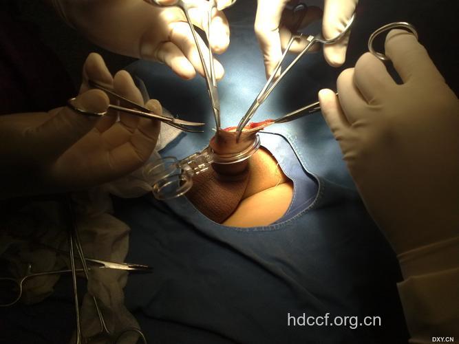 包皮手术的详细过程