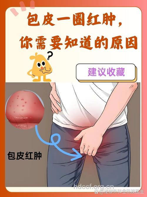 男人包皮过长易发包皮炎