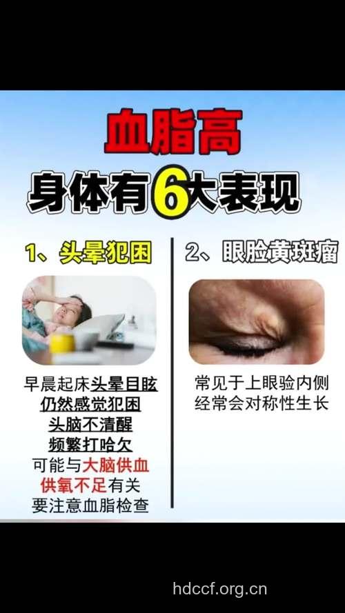 高血脂早期症状有哪些