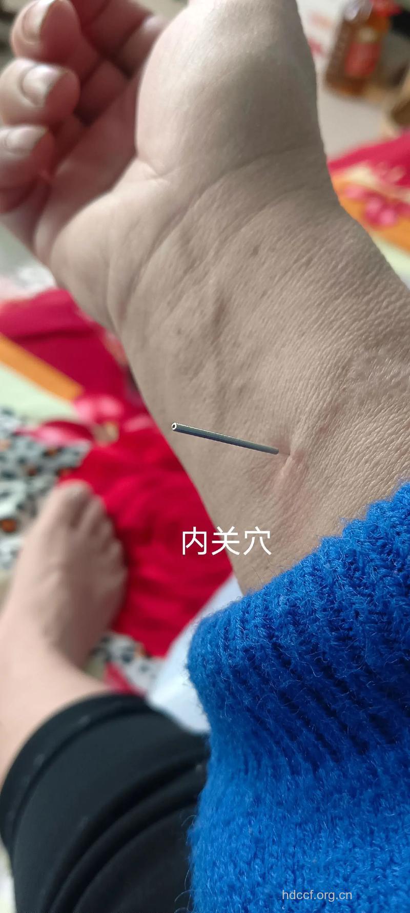 针灸“追斩”高血脂